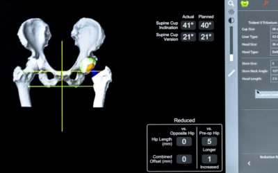 The Benefits of Robotics in Hip Surgery
