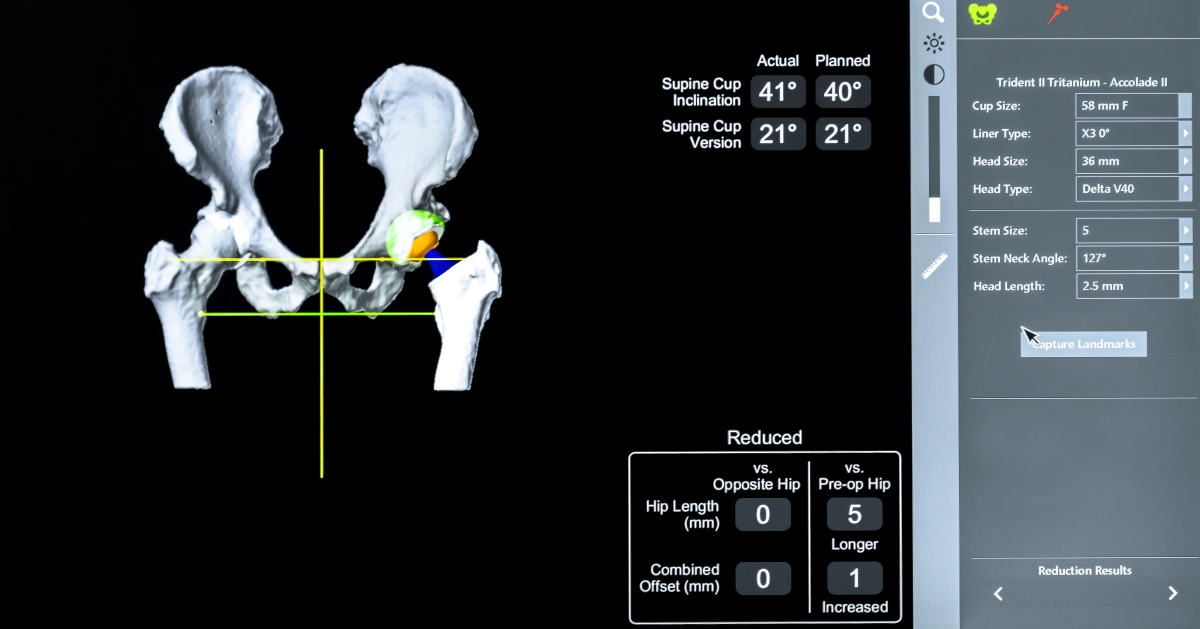 robotics in hip surgery mako procedure