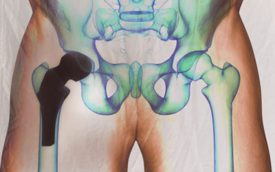 Incidence of Adverse Wear Reactions in Hip Resurfacing Arthroplasty: A Comparison with the Oxford Study