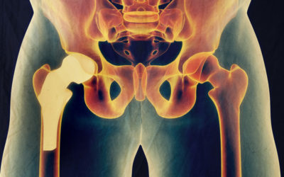 Is Ceramic on Ceramic Hip Resurfacing the New Gold Standard?