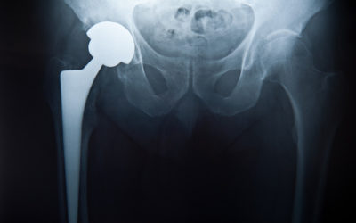 The Ultimate Info Guide for Hip Replacement