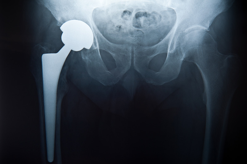 hip replacement guide