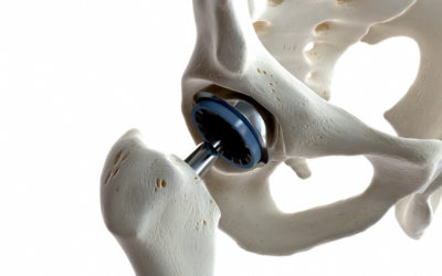 Hip Resurfacing Arthroplasty Guide: Your Joint Replacement 101