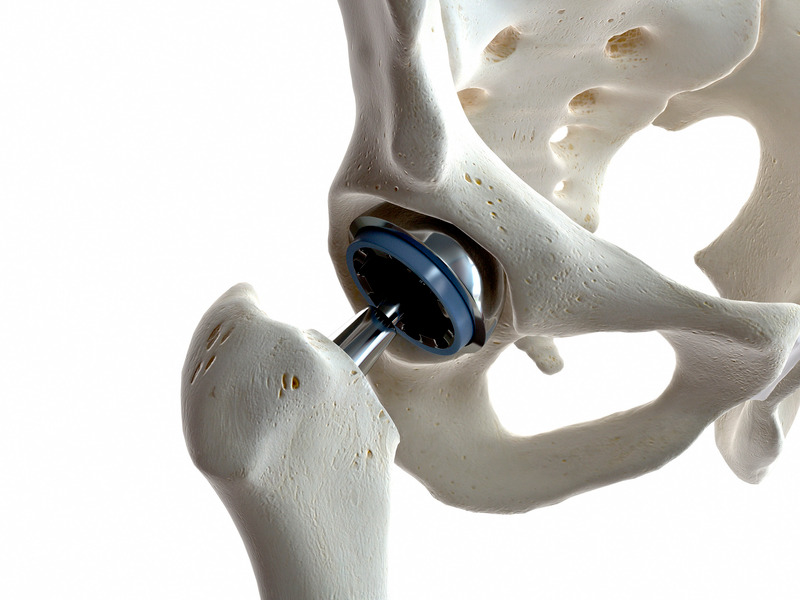 Hip Resurfacing Arthroplasty Guide: Your Joint Replacement 101